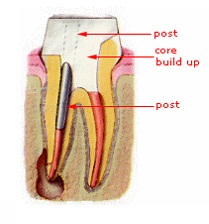 Root Canal Treatment – Step 3
