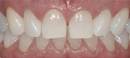 teeth whitening australia dental burpengary
