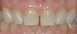 Before Teeth whitening