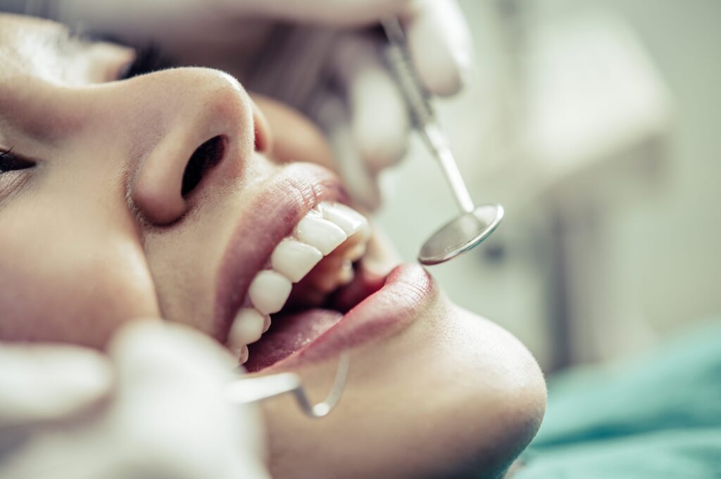 Burpengary Dentist answers “Do I need to Redo my Fillings?”